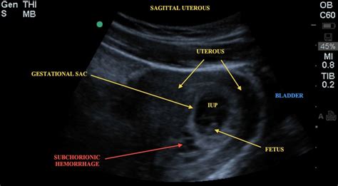 Subchorionic Hemorrhage | Emory School of Medicine