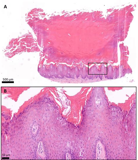 Histology of the plantar keratoderma of the patient, hematoxylin and ...