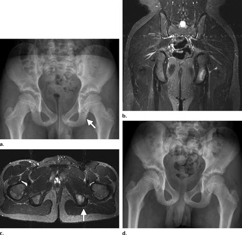 Stress injury of the ischial tuberosity in a 13-year-old male ...