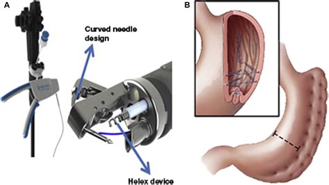 Early Experience With Endoscopic Sleeve Gastroplasty and Hints at ...