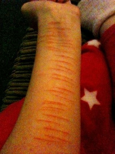 What it looks like - Self-harm is not at all ok