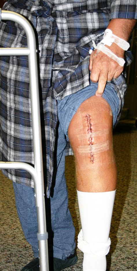 TKR scar (2) - Dr. Stuart Kozinn, MD - TotalKnee.Org Dr. Stuart Kozinn ...