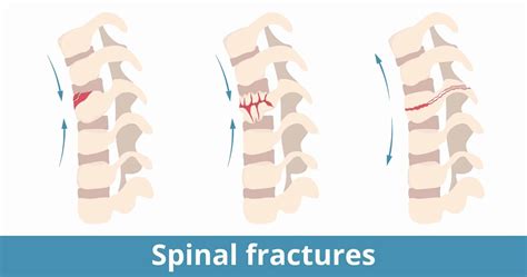 Spinal Fractures: Types, Causes, Symptoms, Diagnosis, and Treatments ...