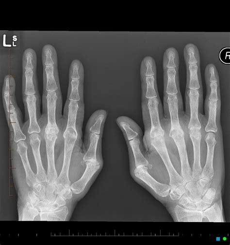 Xray Of Hand With Arthritis