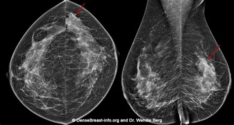 2D/3D Mammography, Density Assessment Software | DenseBreast-info, Inc.