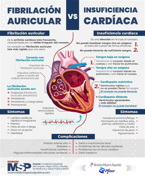 America Artista Inolvidable arritmia cardiaca fibrilacion auricular ...