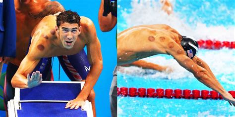 What Is Cupping - What Are Those Circle Marks on Olympic Athletes?