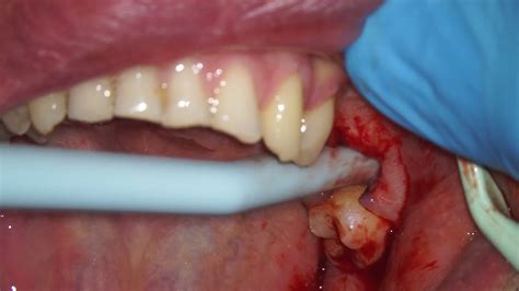 TOOTH ABSCESS PUS DRAINAGE THROUGH EXTRACTION SOCKET - Dental Clinic