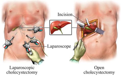 Laparoscopic Cholecystectomy: Indication & Complication » How To Relief