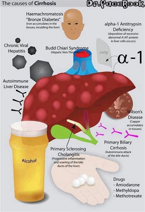 Cirrhosis on the liver | Nursing *tid bits* | Pinterest | Live life