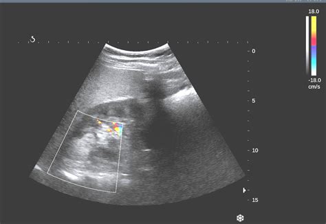 VIETNAMESE MEDIC ULTRASOUND: CASE 354: RIGHT KIDNEY TUMOR, Dr PHAN ...