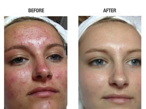 The pros and cons of Acne Laser Treatments - Medi Port Services ...