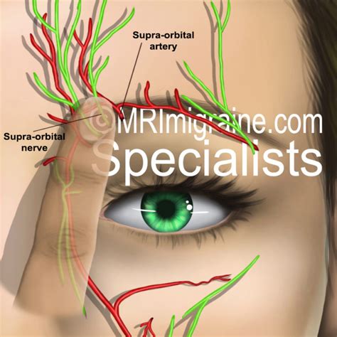 Nerves attached to artery wall – Mrimigraine.com