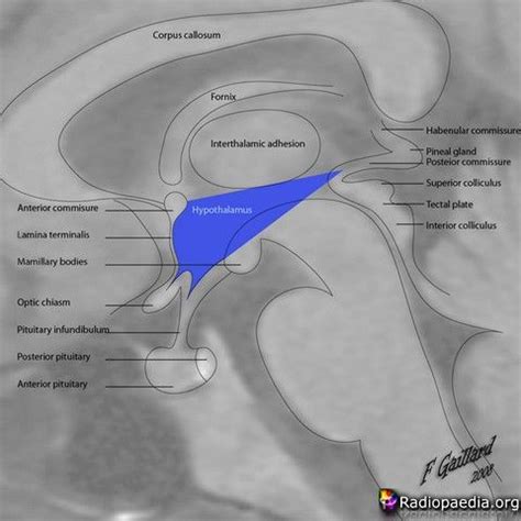 hypothalamus_with_mri | Brain anatomy, Radiology imaging, Pharmacology ...