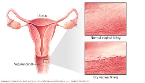 Vaginal atrophy - Symptoms and causes - Mayo Clinic