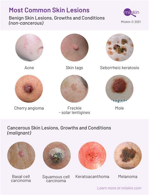 Tumor Skin Lesion