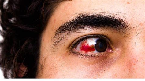 19 Reasons For Having Red Eyes | Bloodshot Eyes Causes