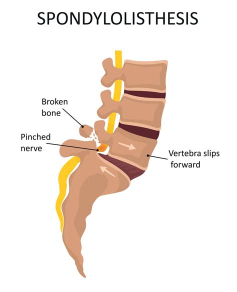 Spondylolisthesis | Ohio State Medical Center