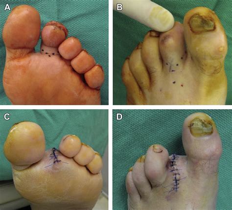 2015 Icd 10 Code For Post Op Amputation Foot