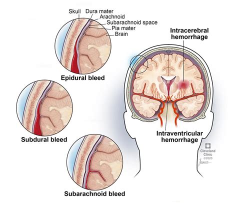 Epidural Hematoma (EDH): Symptoms, Causes & Treatment