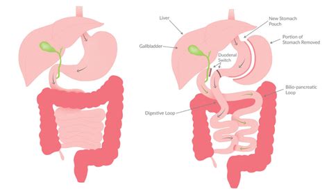 Duodenal Switch Surgery - Heartland Weight Loss Clinic