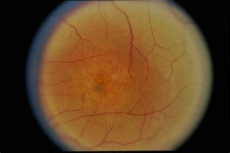 Choroidal Hemangioma - Retina Image Bank