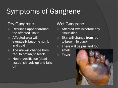 Gangrene - The Dead Tissues! - medical emergency - Santripty