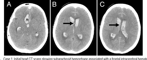 Rupture of anterior communicating artery aneurysms during computed ...