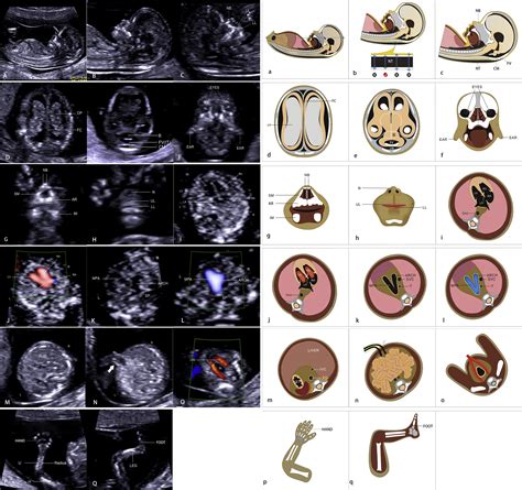 Routine first-trimester ultrasound screening using a standardized ...