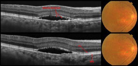 Dots, Spots, and Other White Retinal Lesions – Page 48 of 61 - Retina ...