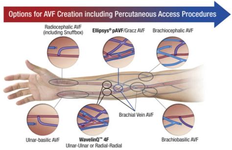 Percutaneous AV Fistula Creation using Ellipsys and WavelinQ – SIR RFS