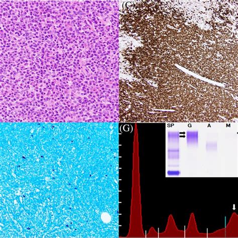 Excisional biopsy of an enlarged inguinal lymph node (A; ×40) with ...