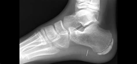 Watch Your Step! Soft tissue foreign bodies in the foot - Cincinnati ...