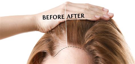 Hair Transplant for Women, Detailed guide in simple steps