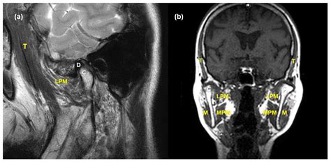 JCM | Free Full-Text | MRI-Based Assessment of Masticatory Muscle ...