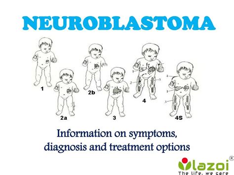 PPT - Neuroblastoma: symptoms, diagnosis and treatment options ...