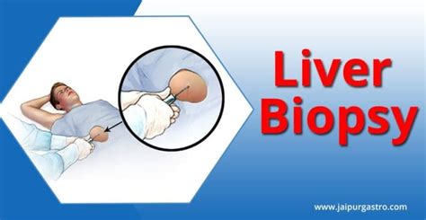 Liver Biopsy Procedure Center in Jaipur | Dr. Shankar Dhaka