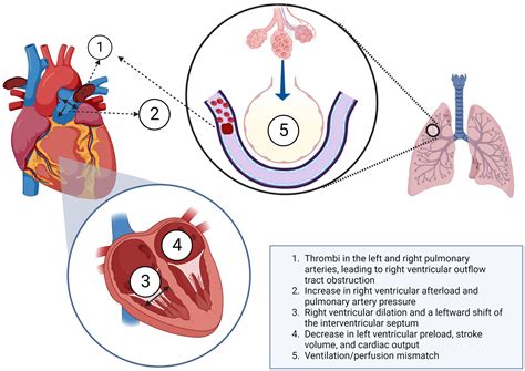 Frontiers | Hemodynamic and respiratory support in pulmonary embolism ...