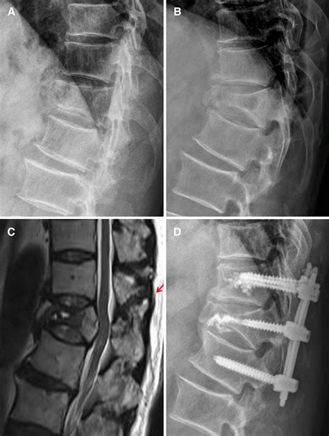 (A) A 64-year-old male patient was initially diagnosed with T12 stable ...