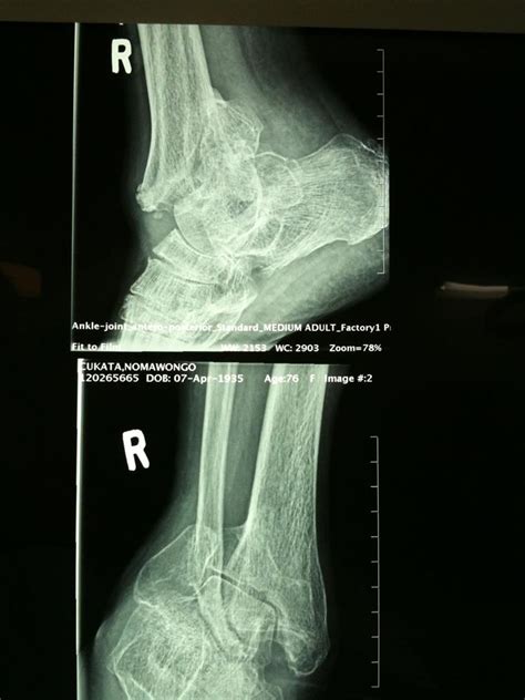 Ankle Arthrodesis - Foot & Ankle - Orthobullets