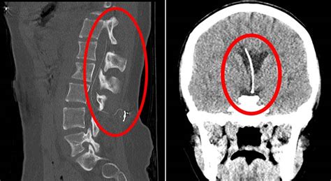 Baclofen pump catheter implanted in brain because tissue couldn’t ...