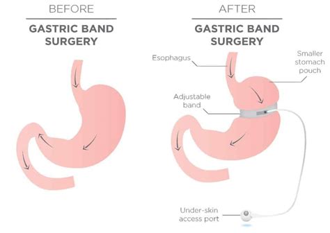 Lap Band Mechanism of Action and The Vagus Nerve - Houston Weight Loss ...