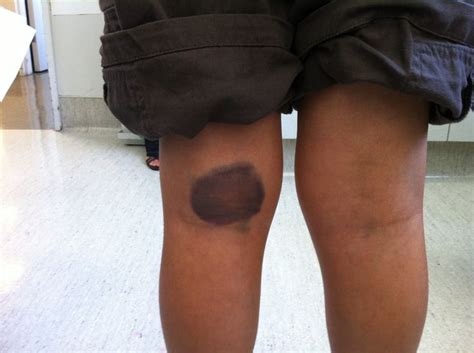 hemophilia bruise. | Hemophilia | Pinterest | Disorders and Factors