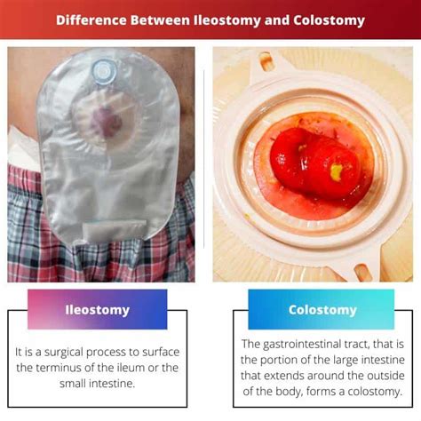 Ileostomy Vs Colostomy Colostomy Ileostomy Ostomy