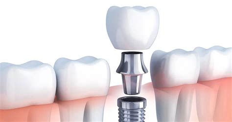 Creating a Great Crown for your Dental Implant