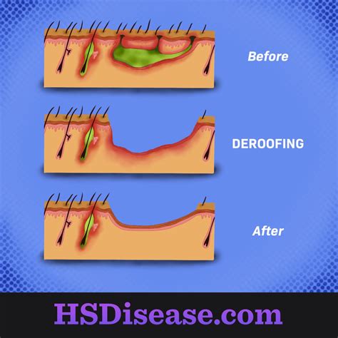 Can Surgery Treat Hidradenitis Suppurativa?