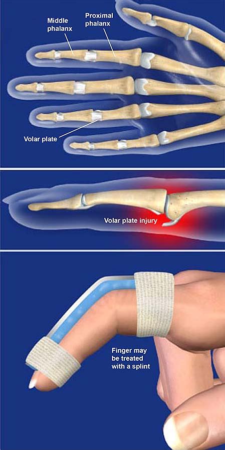 Volar Plate Injuries | Central Coast Orthopedic Medical Group