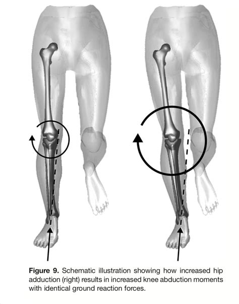 Greg Lehman on Twitter: "@markk42k was associated with knee pain. So ...