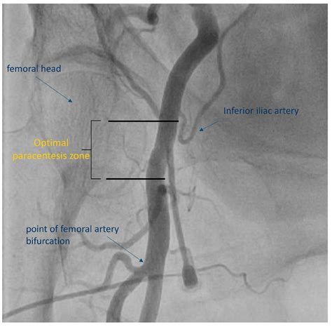 Diagnostics | Free Full-Text | Ultrasound-Guided Femoral Vascular ...