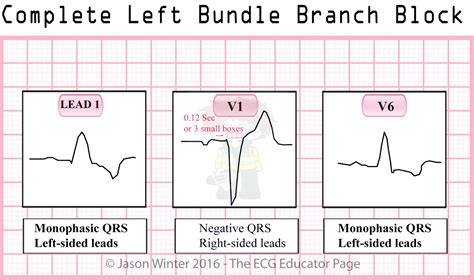 ECG Educator Blog : Bundle Branch Blocks